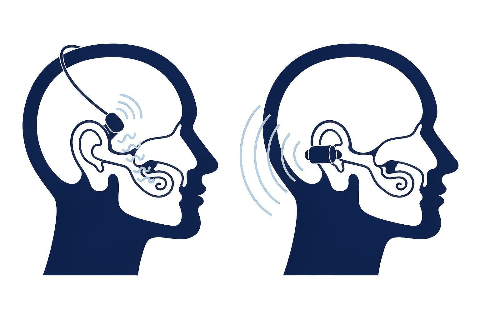 Flat navy and white illustration of two head profiles side by side, one with a transducer pad on the cheekbone sending vibration through the skull to the cochlea, the other with a speaker sending sound waves through the air into the open ear canal